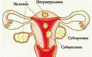 Субмукозная миома матки