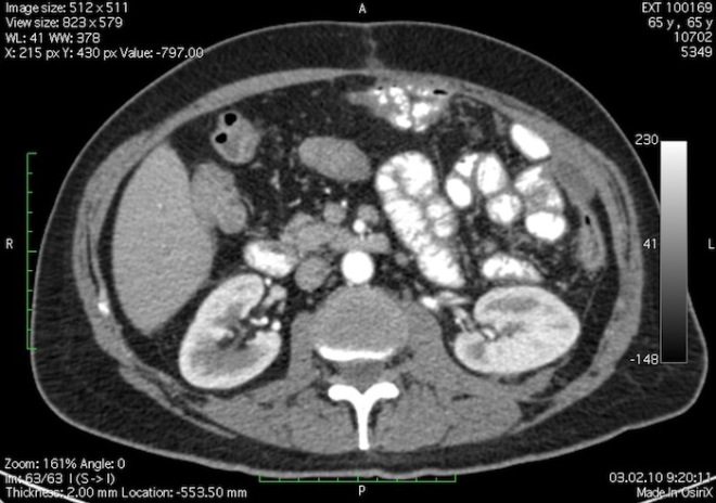 Снимок КТ почек