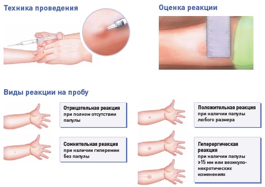 Туберкулиновая проба, расшифровка