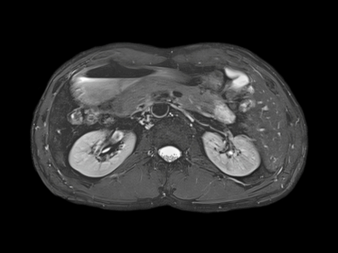 Снимок почек на МРТ