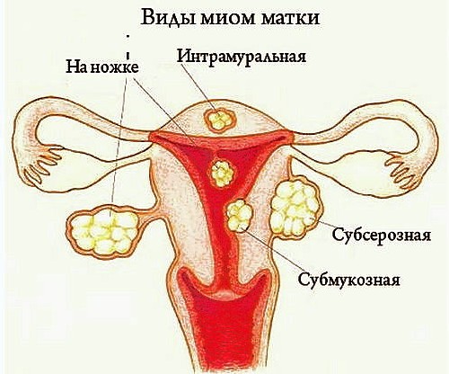 Субмукозная миома матки 