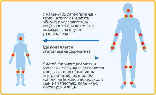 atopic1