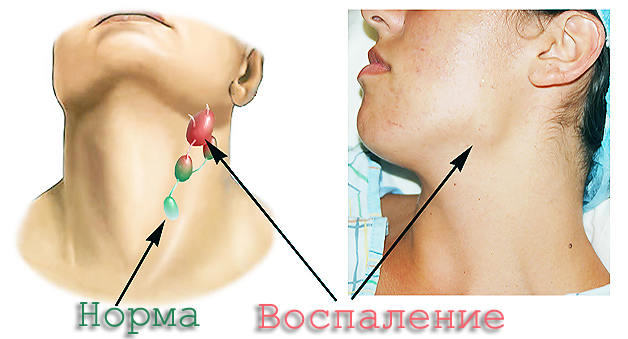 Гигрома на шее у беременных