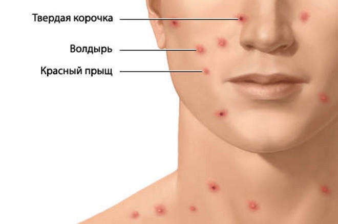 Основные симптомы